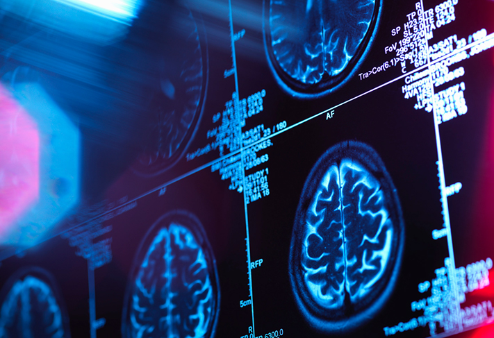 Brain scan on screen